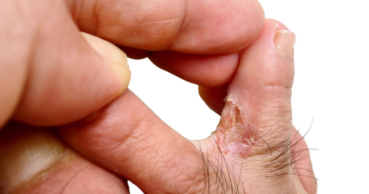 man infected with athletes foot wondering what the best athletes foot treatment is for him