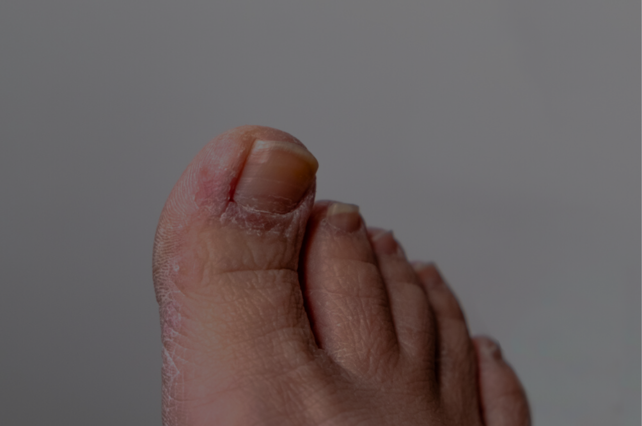 man desperate to learn how to prevent athletes foot from coming back