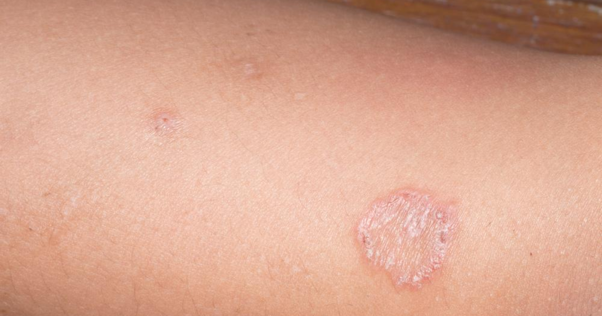 Itchy Red Circular Rash — It could be ringworm!