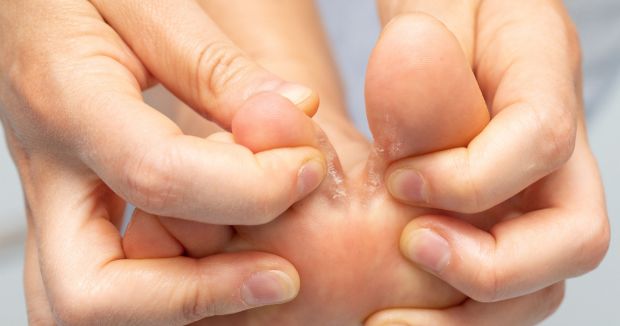 person wondering if they have foot eczema figuring out cause based on location of irritationor athletes foot