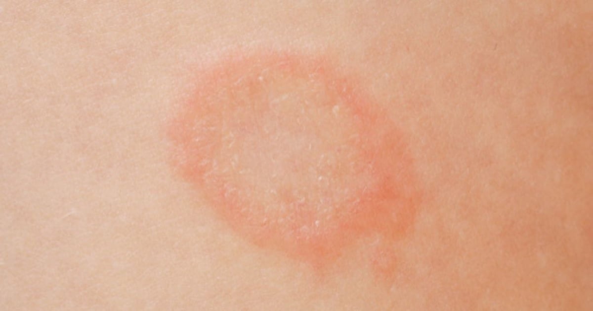 skin rashes are one of the most common ringworm symptoms