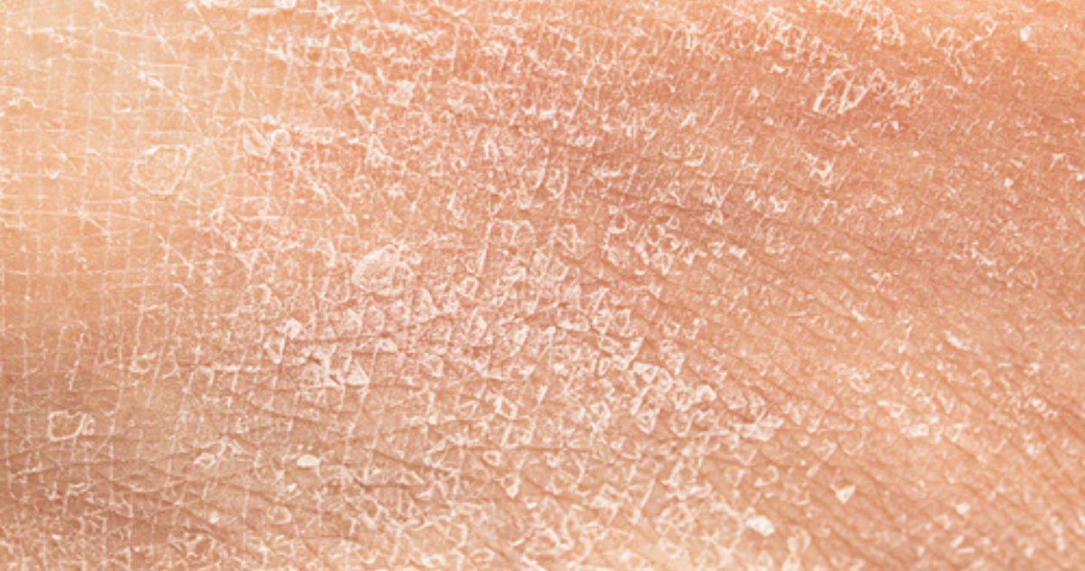 dry flaky skin is a symptom of ringworm