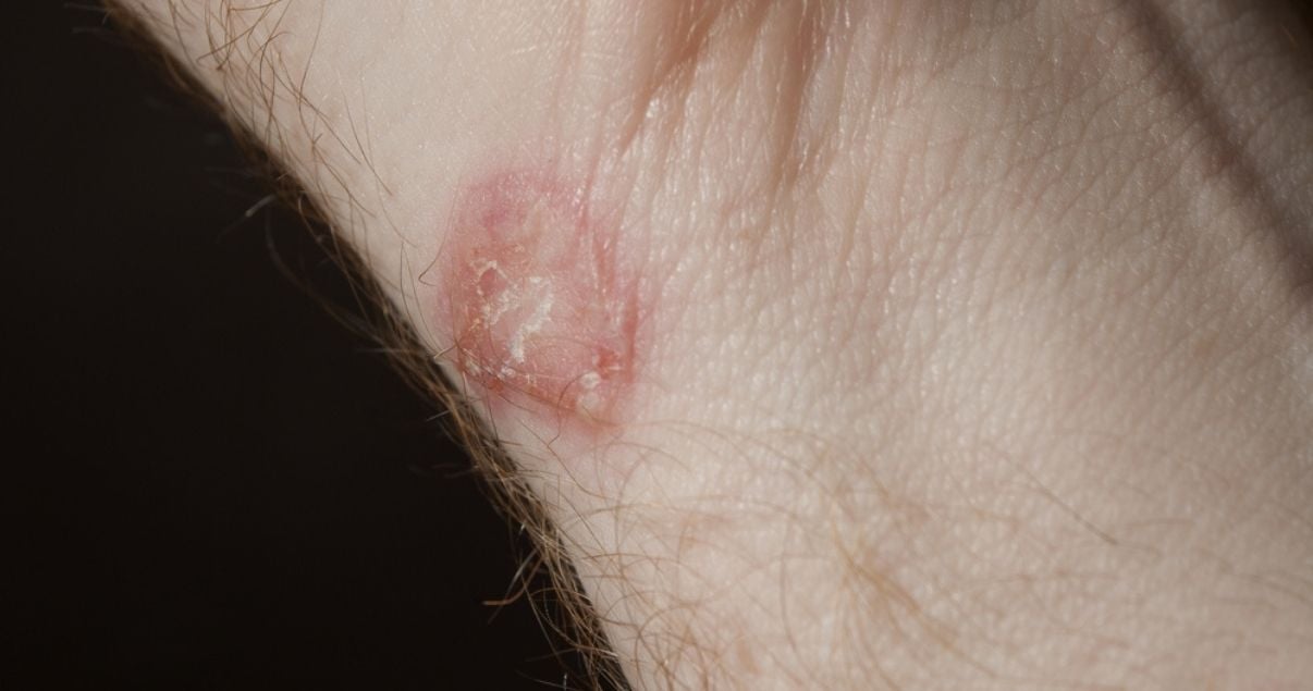 tinea cruris is a symptom of ringworm