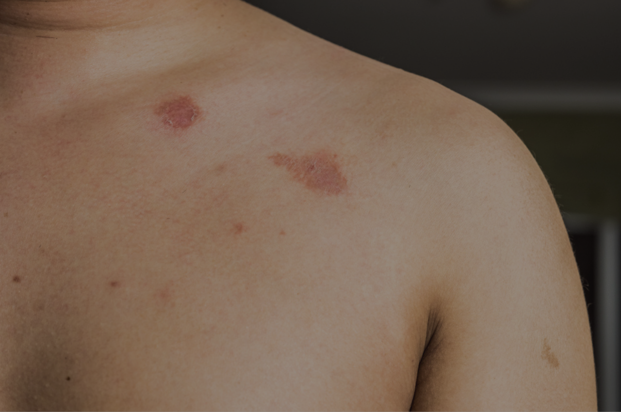 is ringworm contagous? yes