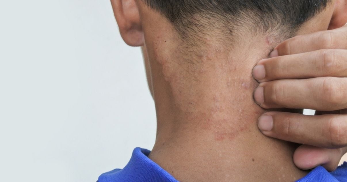 man scratching ringworm rash