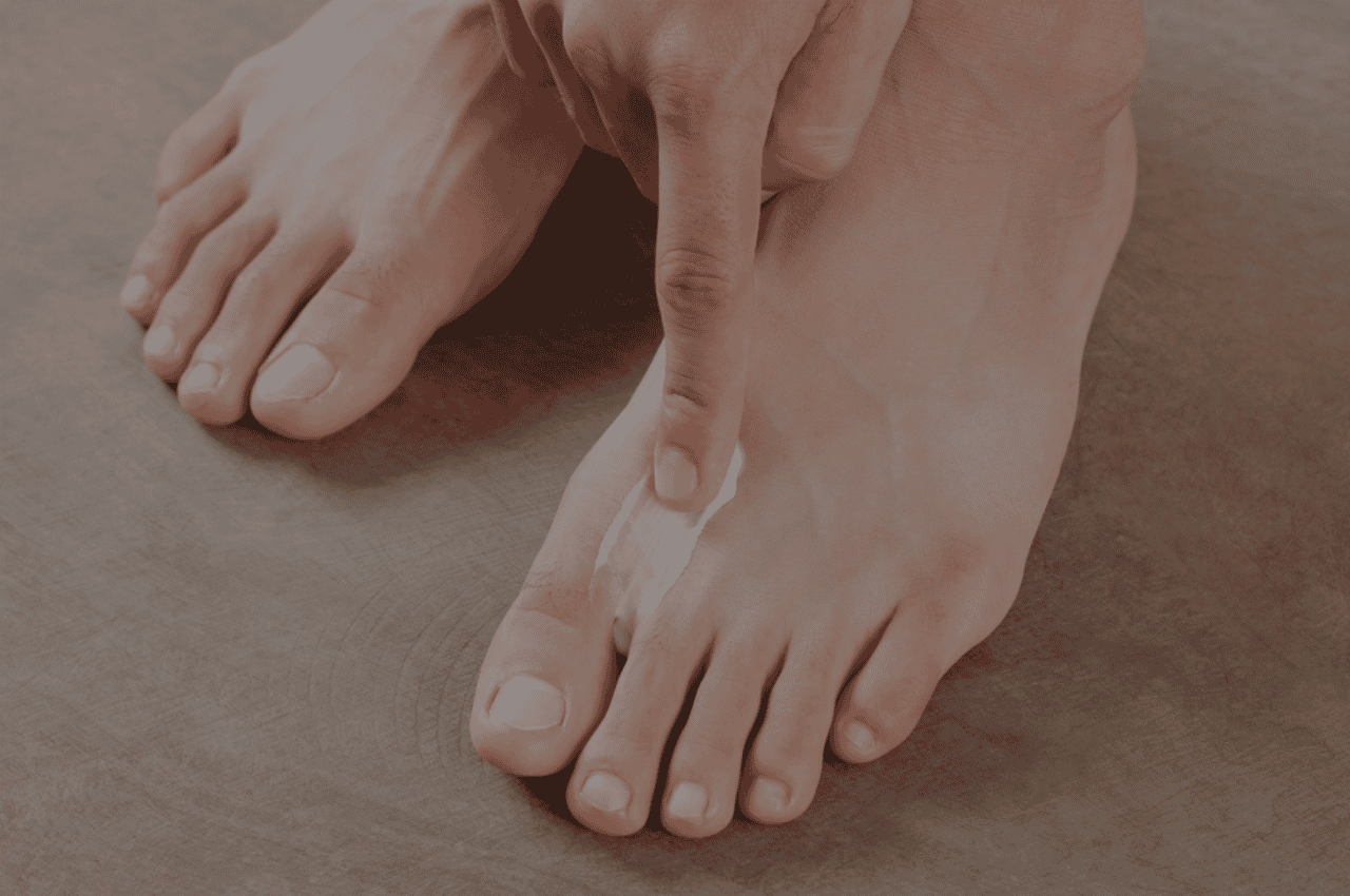 cure athlete's foot at home fast with silka cream