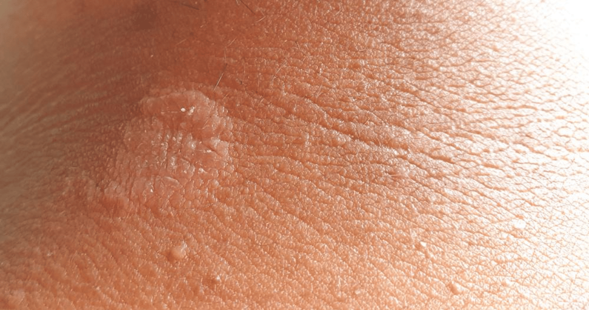 Jock Itch And Itchy at Dennis Aguayo blog