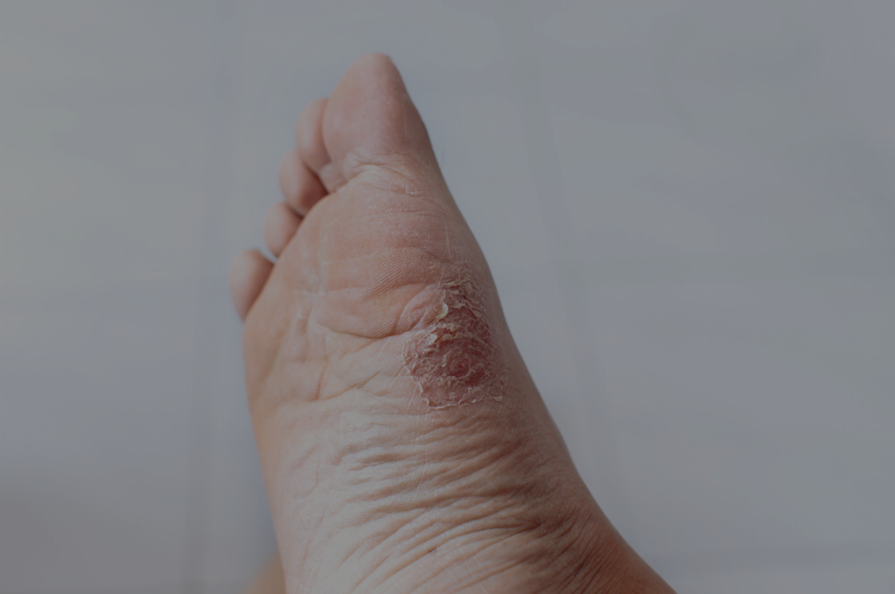 how to prevent athletes foot with athelte's foot images