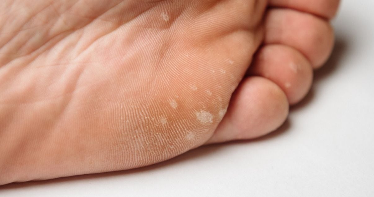 mild case of athletes foot